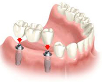 Dental Implants | Westfiled MA